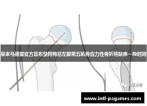 皇家马德里官方宣布楚阿梅尼左脚第五跖骨应力性骨折将缺席一段时间 皇家马德里官方宣布楚阿梅尼左脚第五跖骨应力性骨折将缺席一段时间